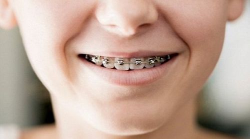 Брекеты опасны для зубов и десен детей